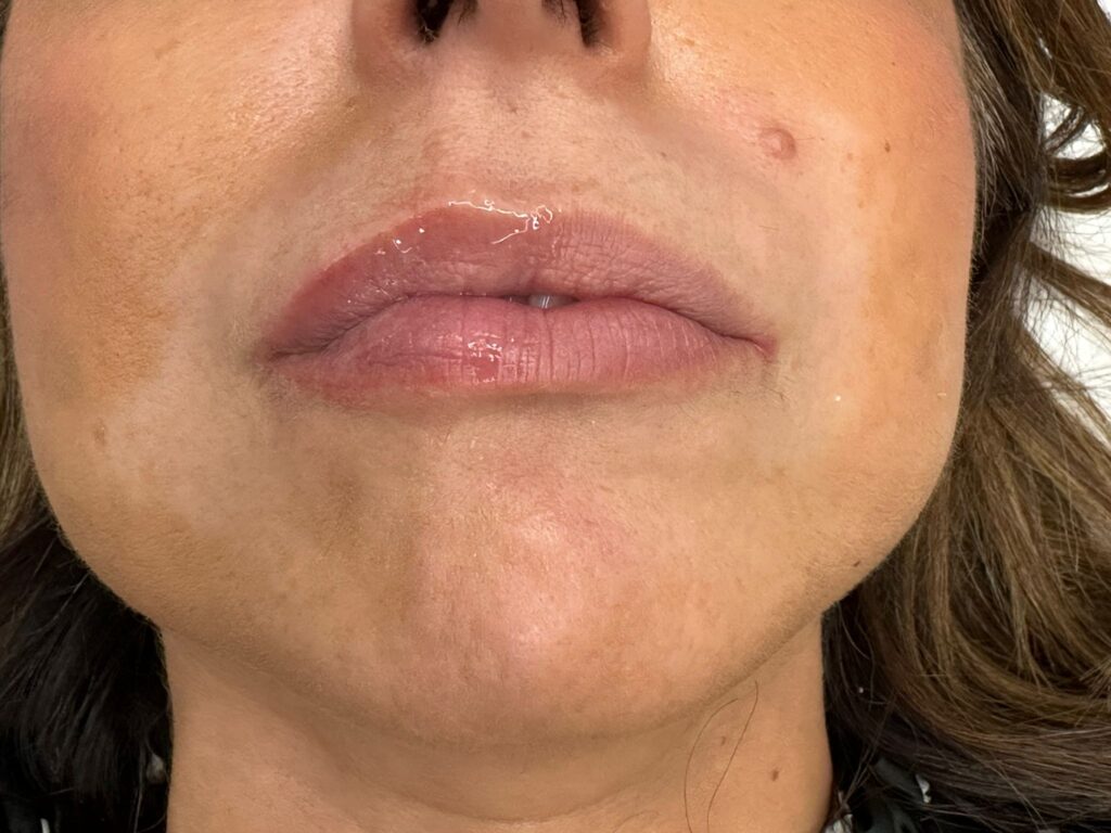 labios con volumen sin cirugia
