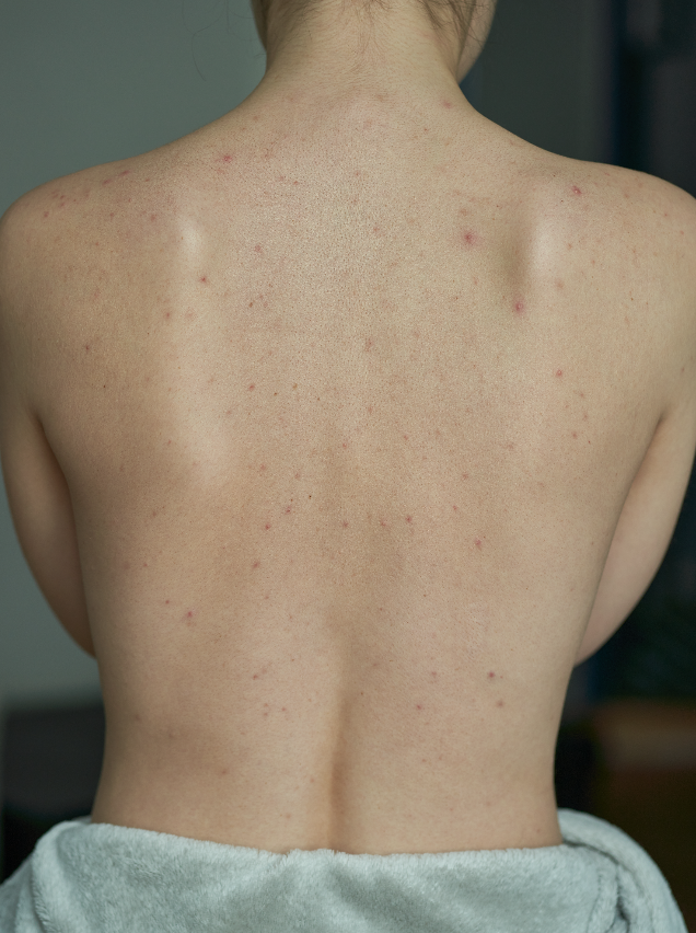 dermapen zaragoza eliminar acne